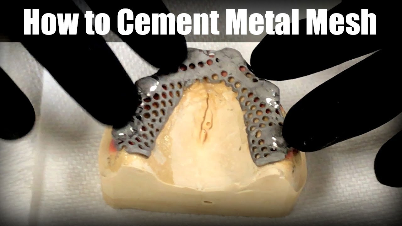 How to Cement a Metal Mesh Framework to Locators®