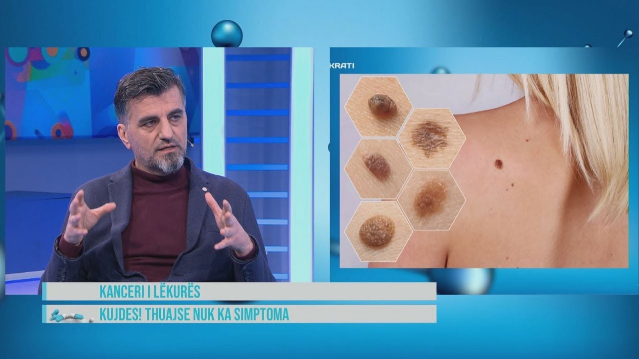 Hipokrati – Kanceri i lëkurës, shenjat që nuk duhet të neglizhojmë! Urgjent tek dermatologu