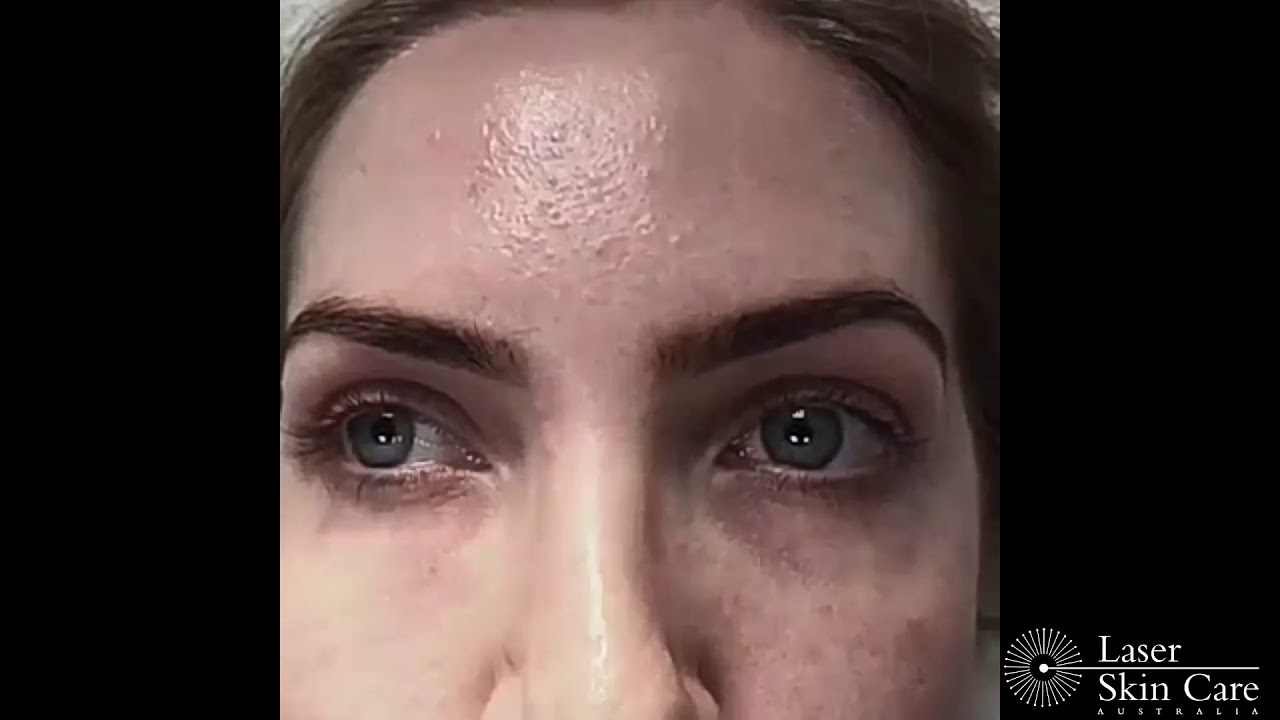 Tear Trough Filler Treatment - Under Eye Fillers