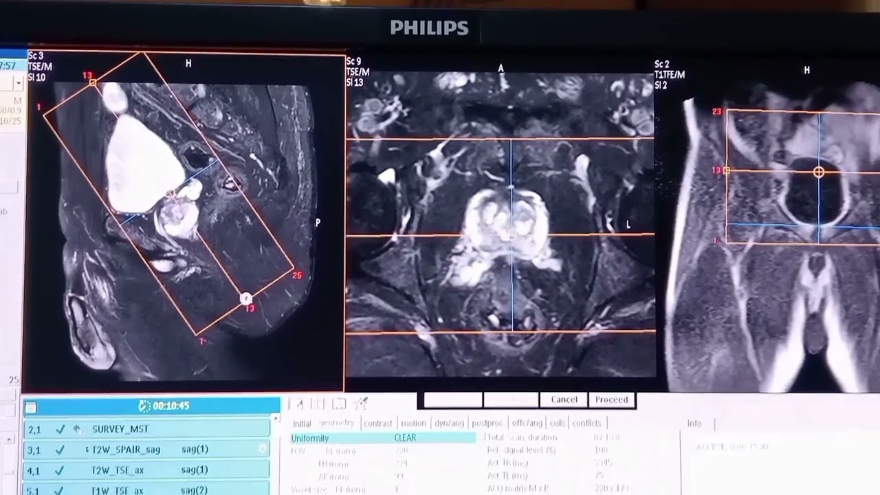 #MRI_prostate##رنين_مغناطيسي_علي_البروستاتا#رنين_مغناطيسي