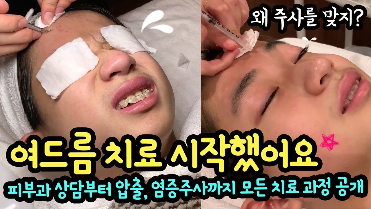 마이린 여드름 치료 시작했어요 (피부과 상담부터 딥클렌징, 압출, 염증주사, 진정관리, 팩까지 치료 과정 모두 공개) 마이린 TV