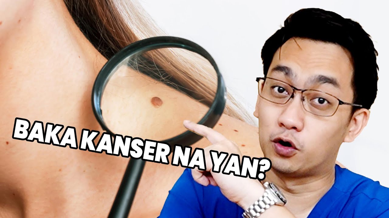 Nunal mo&hellip;baka KANSER na?? | Dr. Dex Macalintal