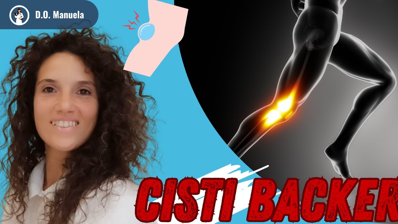 🔥CISTI DI BAKER: cos'è e come affrontarla