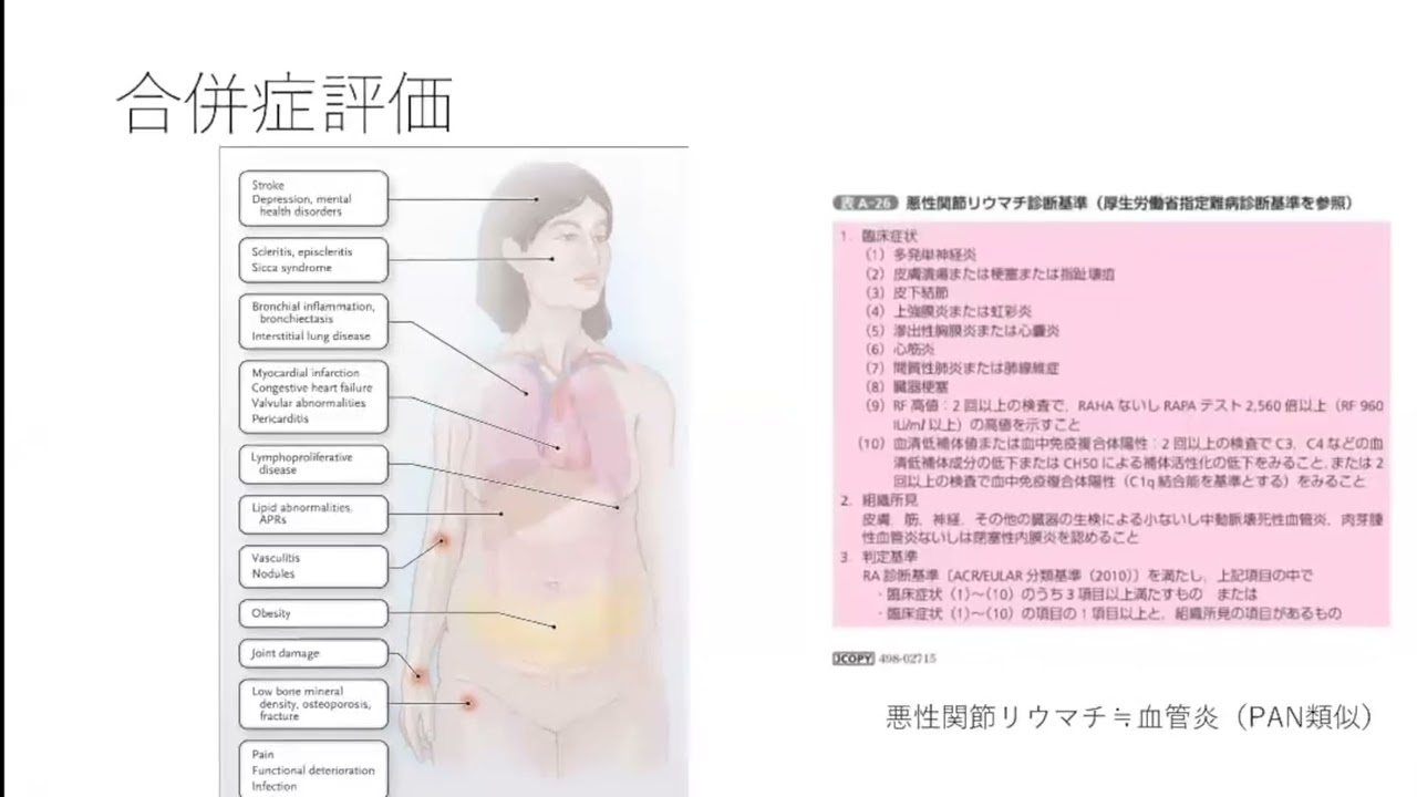 関節リウマチ