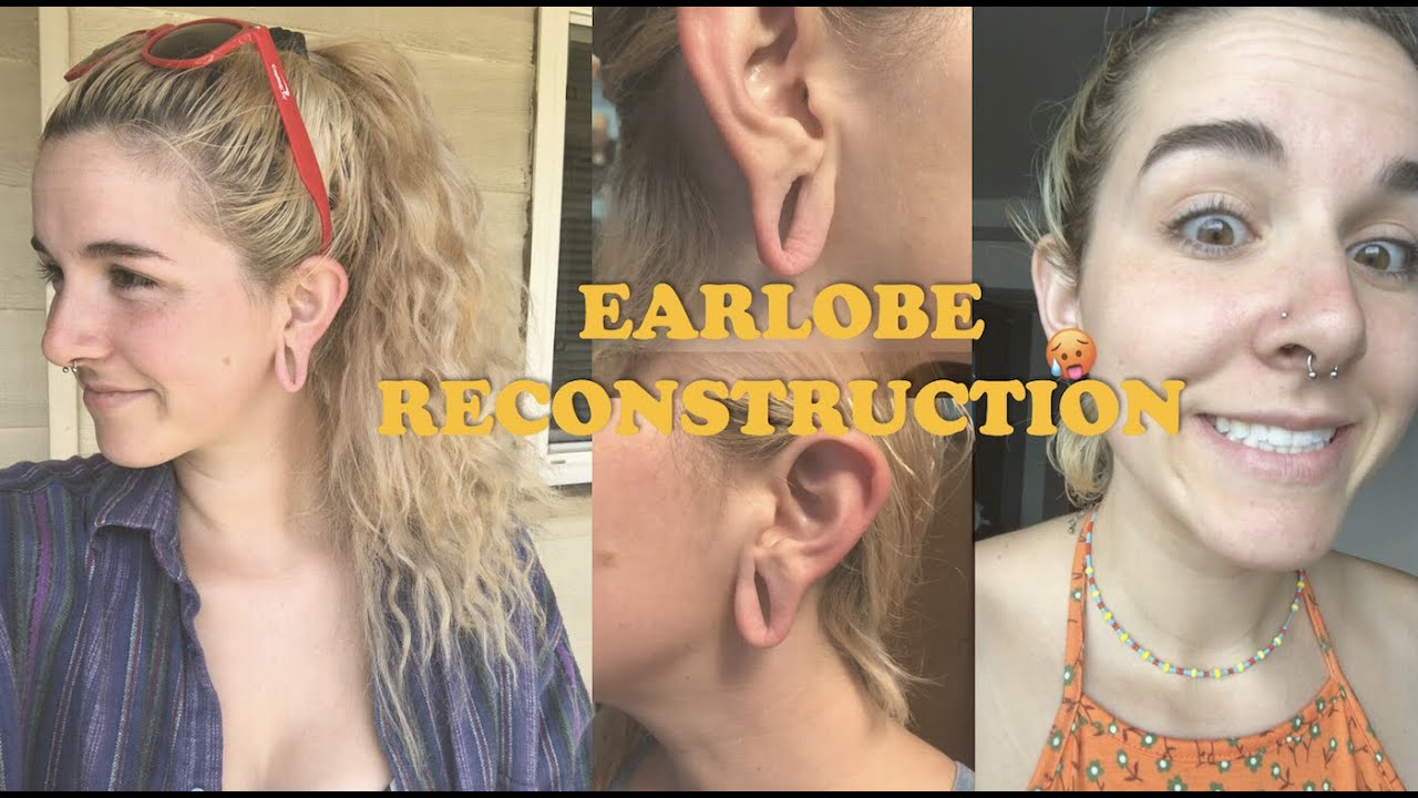 I GOT MY EARLOBES RECONSTRUCTED