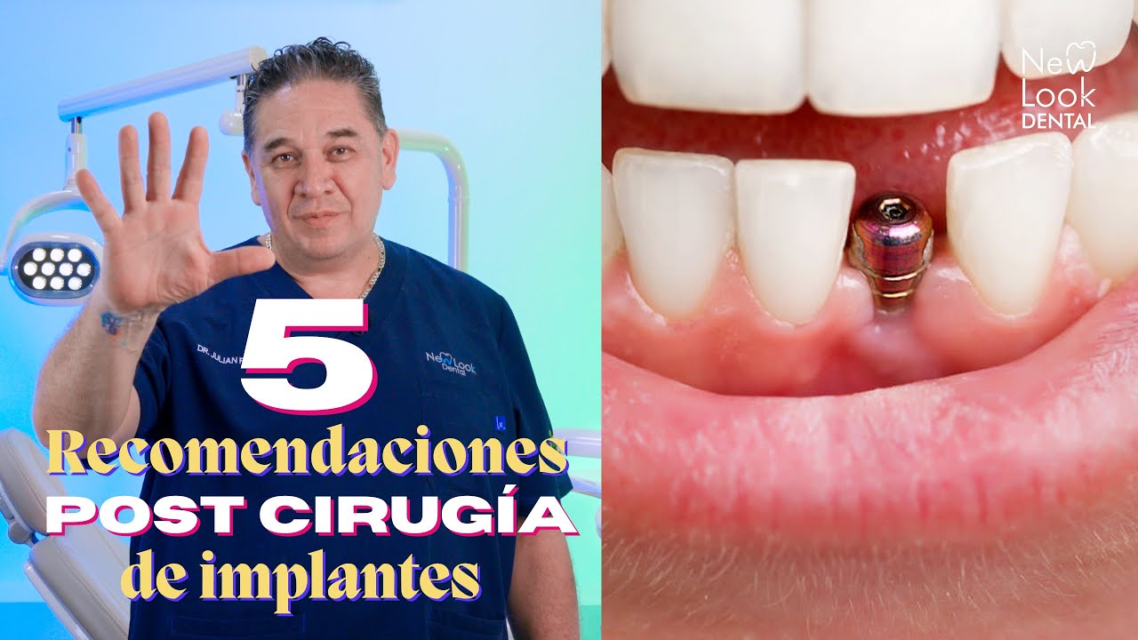 5 Recomendaciones post cirug&iacute;a de implantes dentales 🦷😁
