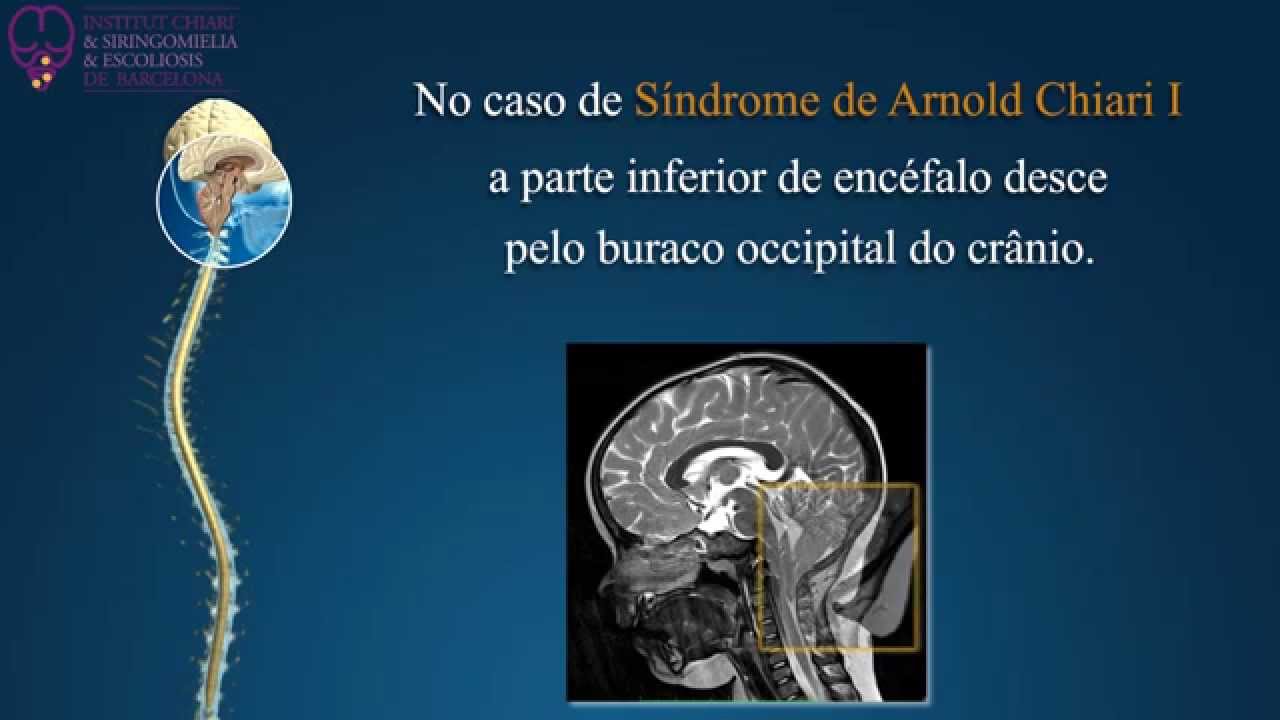 Sindrome de Arnold Chiari I, Siringomielia e Escoliose - Institut Chiari de Barcelona