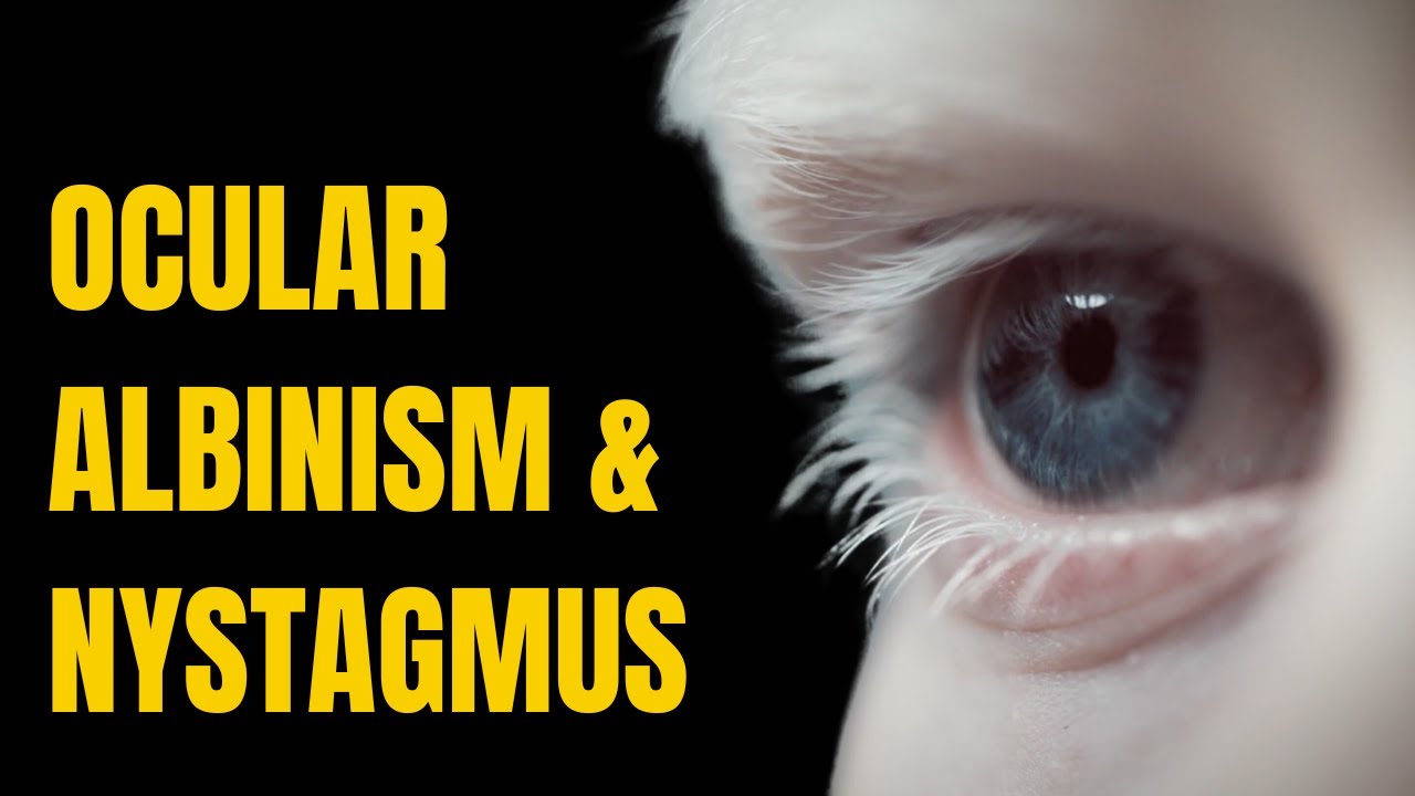Success Treating Ocular Albinism Related Nystagmus, & Poor Eyesight