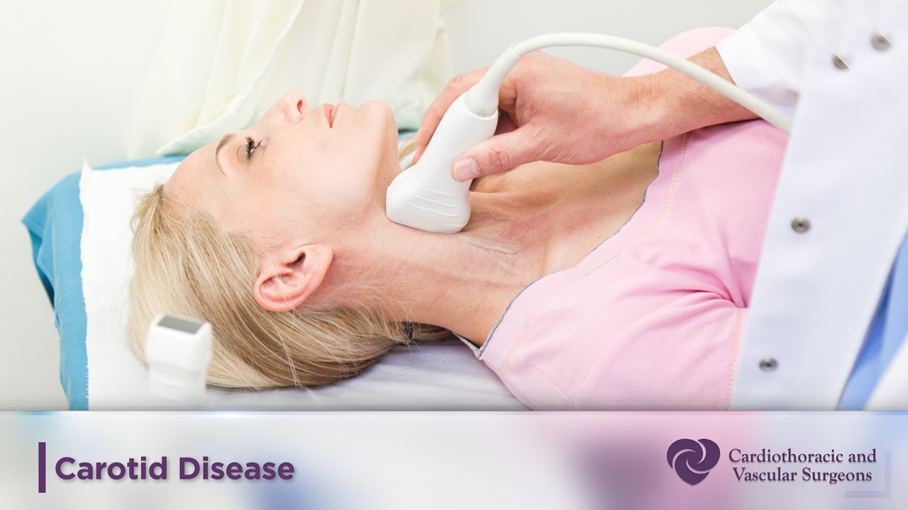 Carotid Disease | Cardiothoracic and Vascular Surgeons | CTVS Texas
