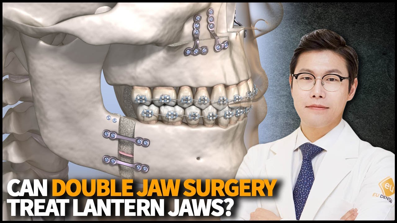 Can Double Jaw Surgery treat Lantern Jaws? Should we do Rhinoplasty or Double Jaw surgery first?