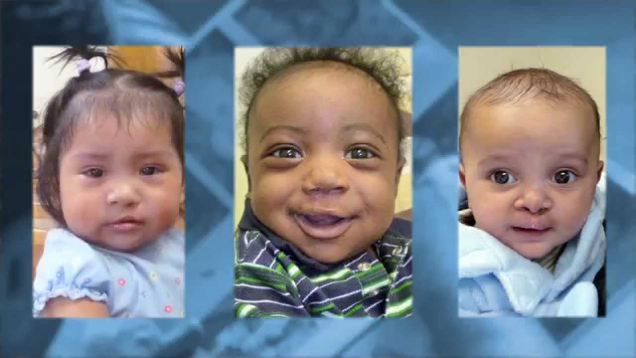 Cullen's story  l  Cleft lip and palate