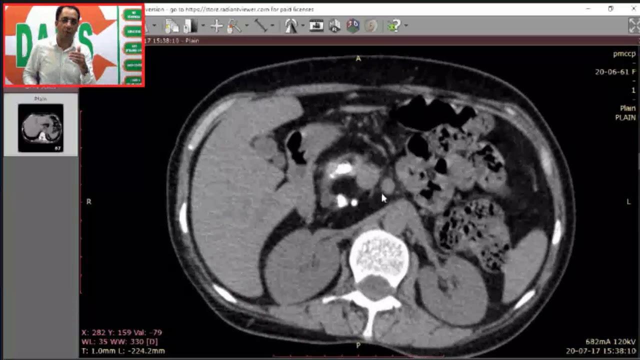 #DAMS #Unplugged #Chronic #Pancreatitis #CT