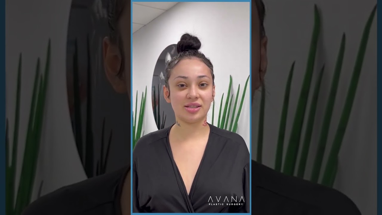 3 days post-op: BBL + 360 lipo with Dr Hasan l Avana Plastic Surgery