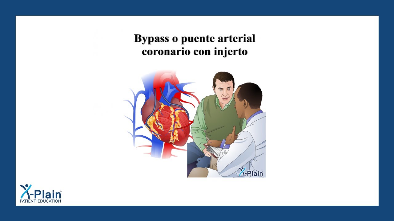 Bypass o puente arterial coronario con injerto