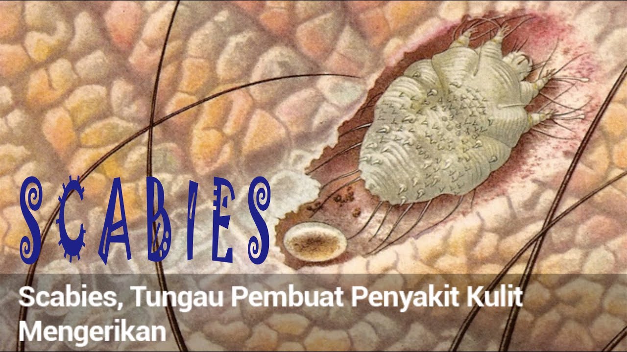 SCABIES (KUDIS), Definisi, Gejala, Penyebab, Pengobatan, pencegahan dan komplikasi