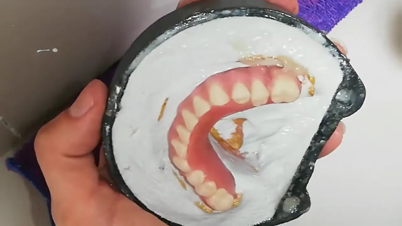 PROCESO DE ENFRASCADO PROTESIS TOTAL INFERIOR CON 4 IMPLATES1