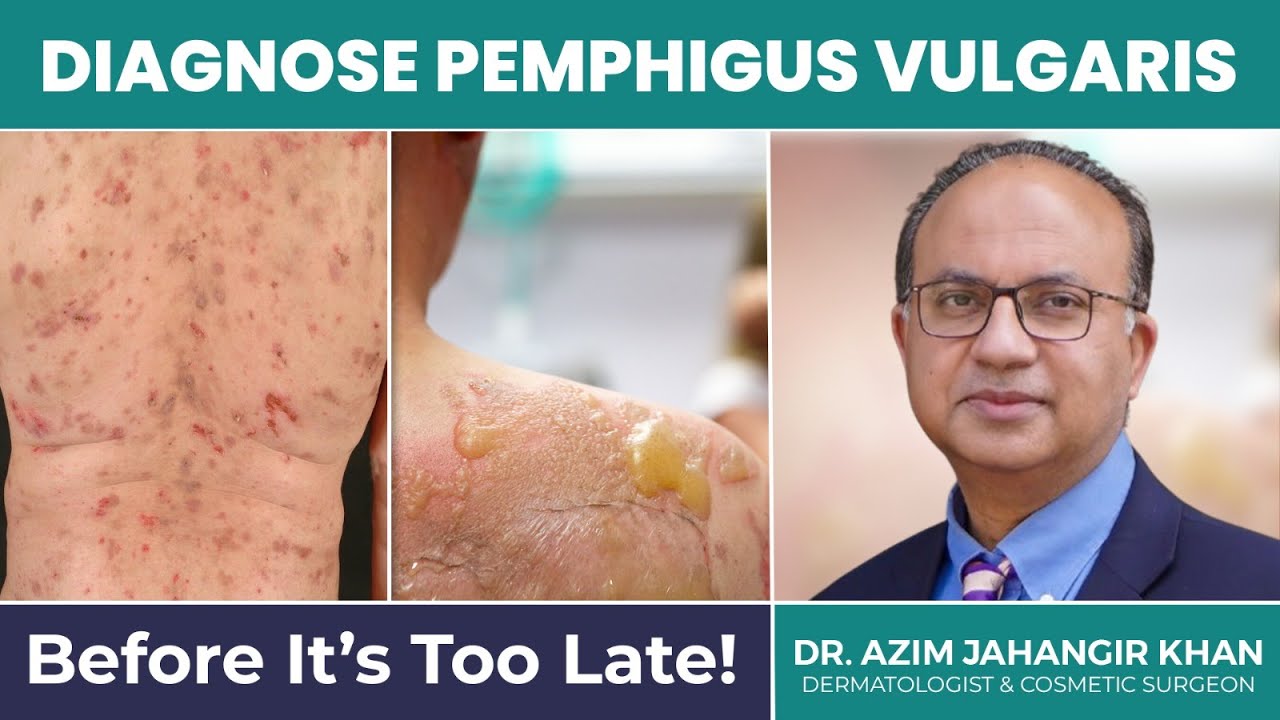 Pemphigus Vulgaris – Deadly but Treatable! Get Expert Insights with Dr. Azim Jahangir Khan