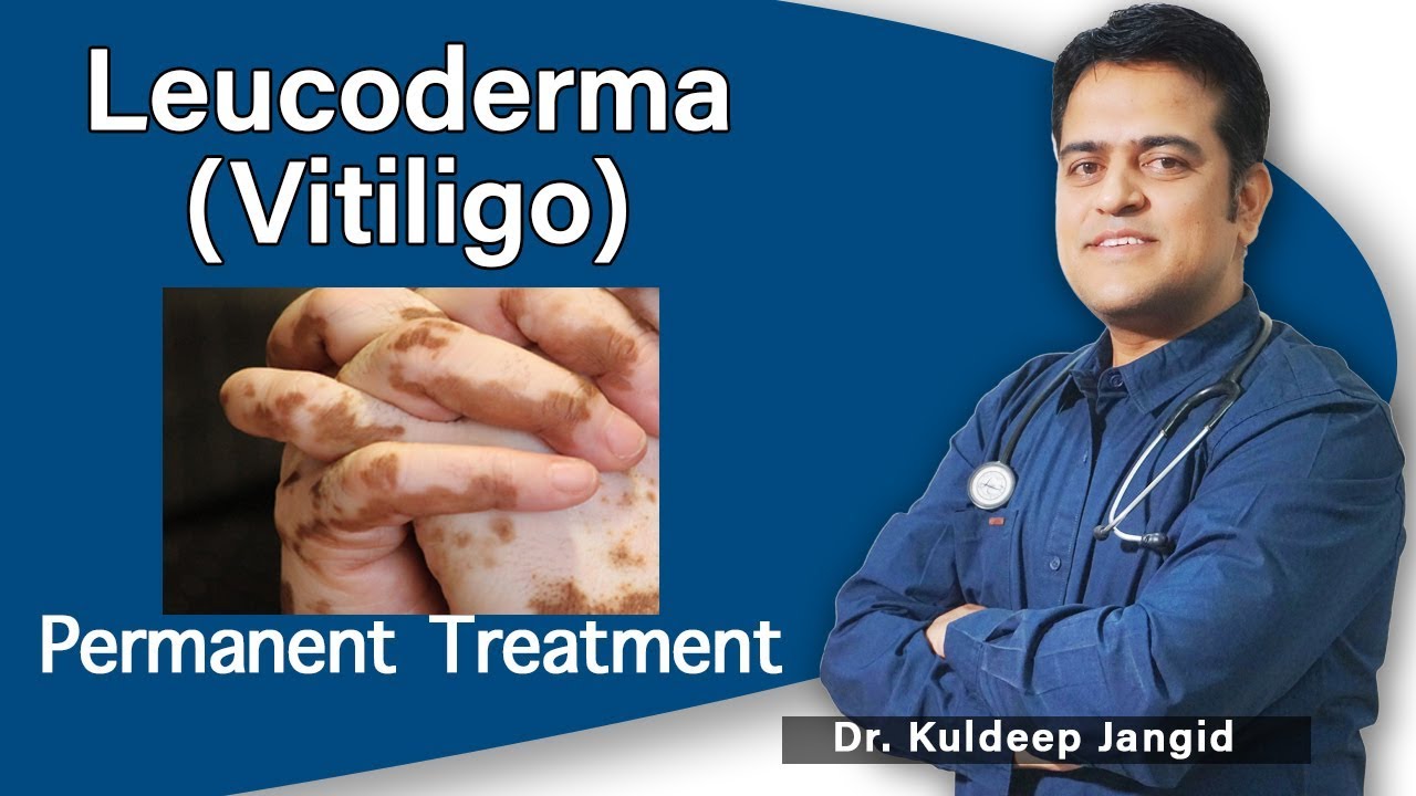Best Homeopathic Treatment of Leucoderma or Vitiligo | सफ़ेद दाग का इलाज | Best Homeopathic Doctor