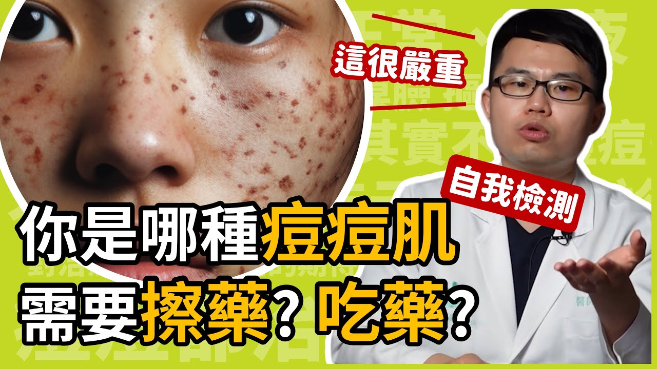 你是哪種痘痘肌？長兩顆痘痘算嚴重？應該吃藥、還是擦藥呢？皮膚科楊省三醫師教你自我檢測痘痘嚴重程度！
