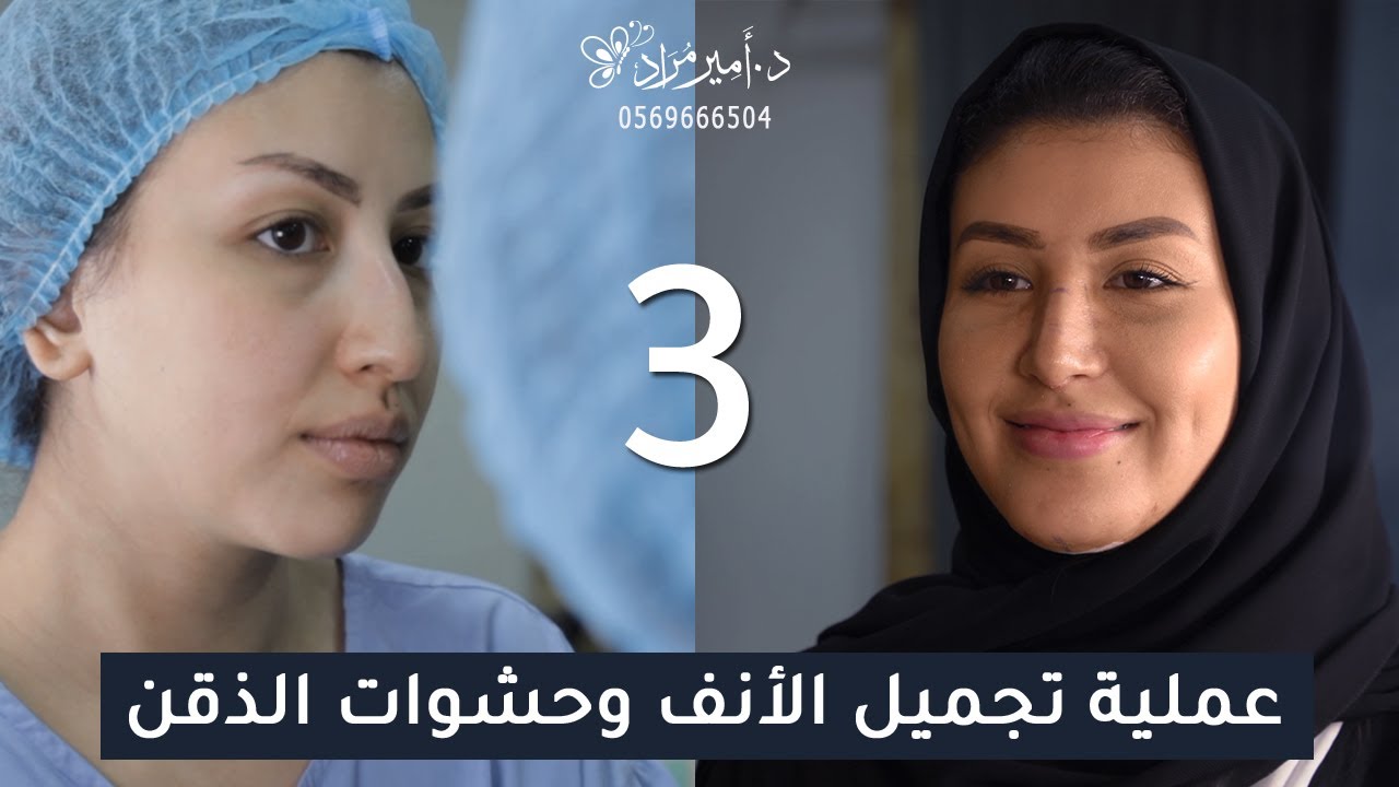 عملية تجميل الأنف وحشوات الذقن إبداع مع الاستشاري دكتور أمير مراد