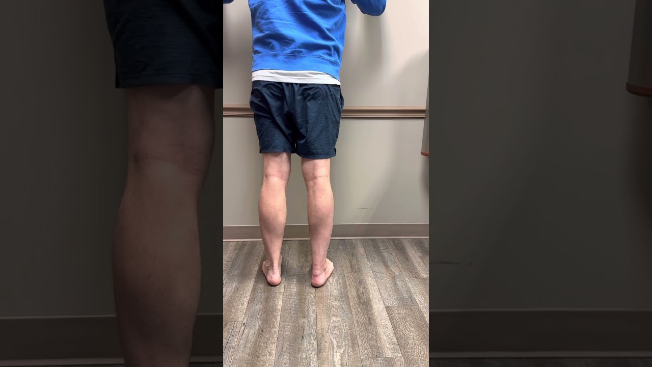 Ruptured Achilles treated non-surgically with a cast, Part 4