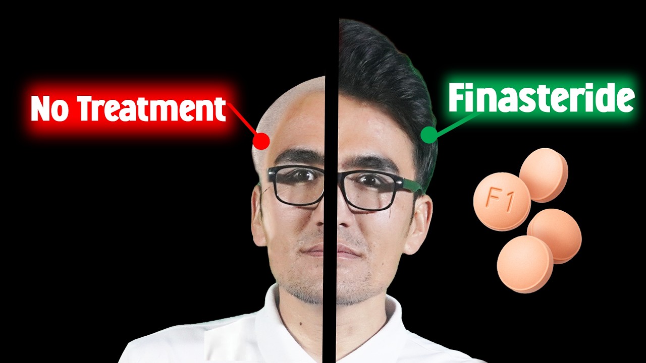The Truth About Finasteride: Hair Loss Cure or Dangerous Drug?