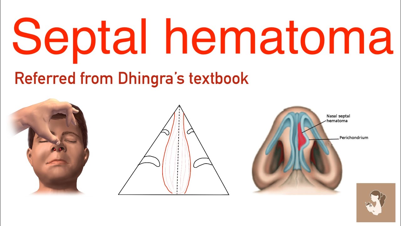 Septal hematoma | Dhingra | ENT | UT exam