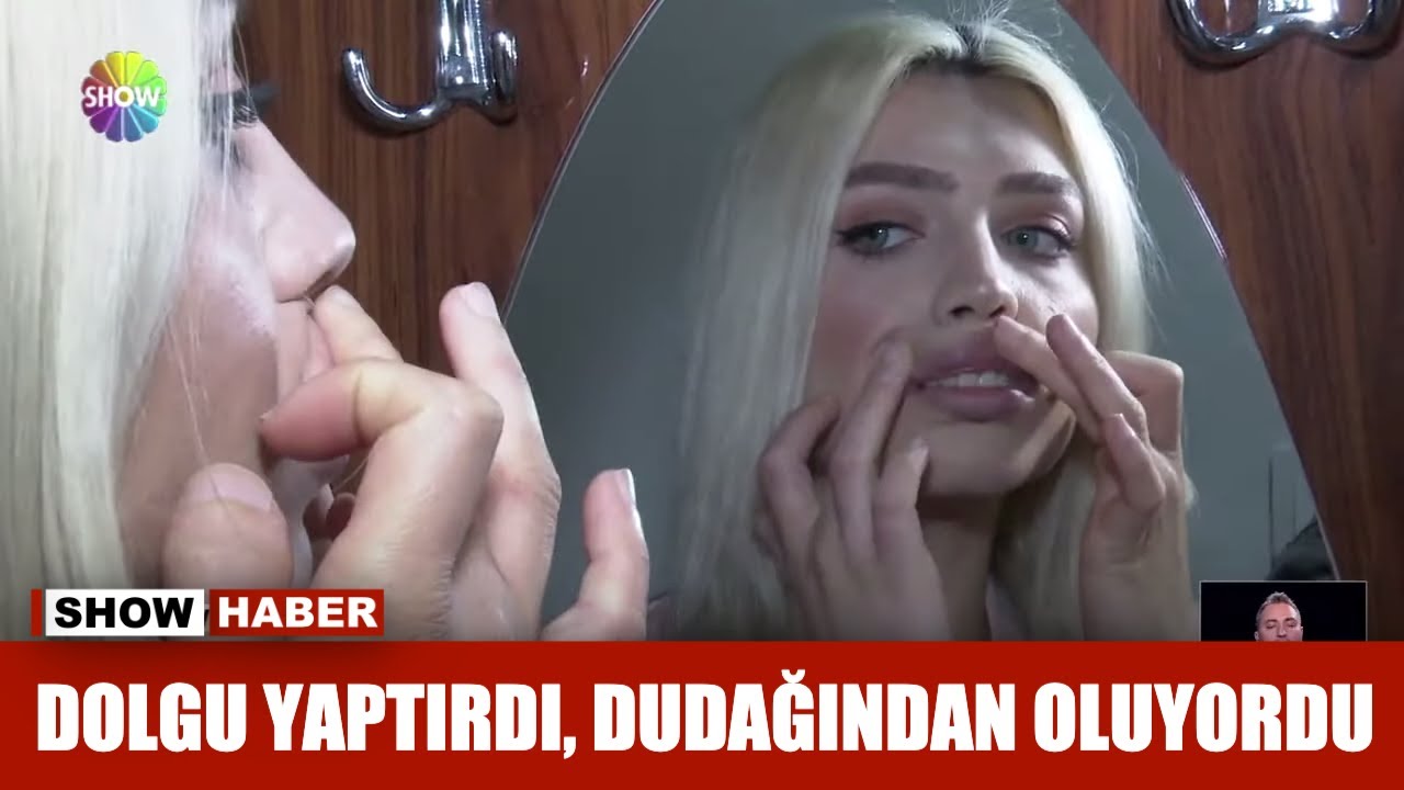 Dolgu yaptırdı, dudağından oluyordu