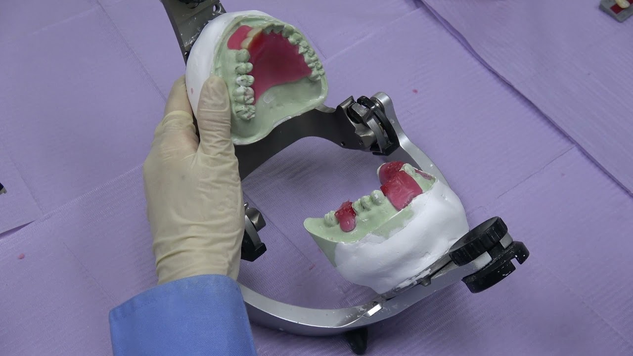 Setting up teeth for partial denture (Acrylic)