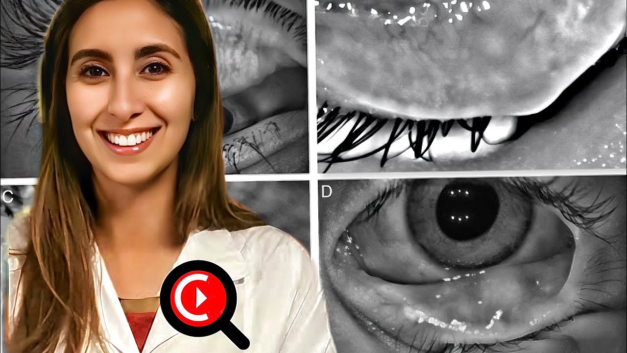 DISFUNCIÓN DE GLÁNDULAS DE MEIBOMIO 👁️. Dra. Natalia Ramón