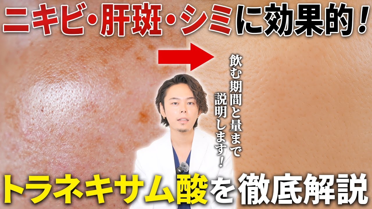 【肝斑・美白治療】トラネキサム酸の効果について最新の論文データをもとに医師が解説