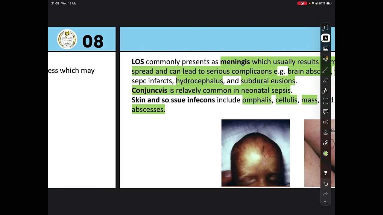 د ربيع 2 /  Neonatal sepsis , NEC
