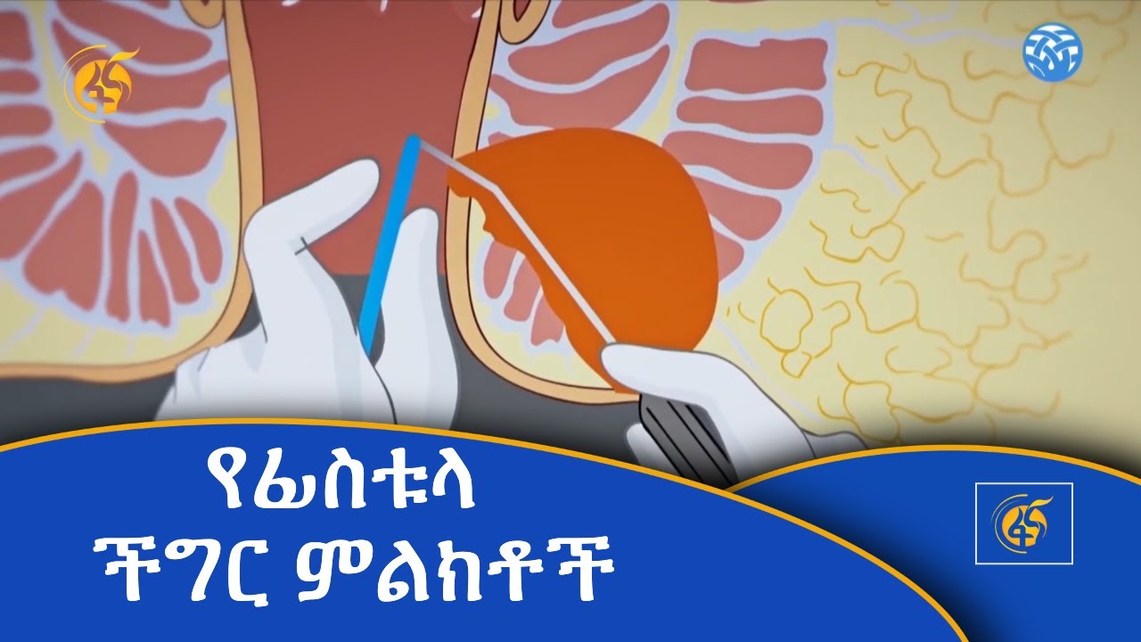 የፊስቱላ ችግር ምልክቶች