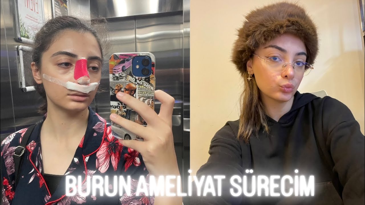 Burun Ameliyat Vlog & &Ouml;nerilerim