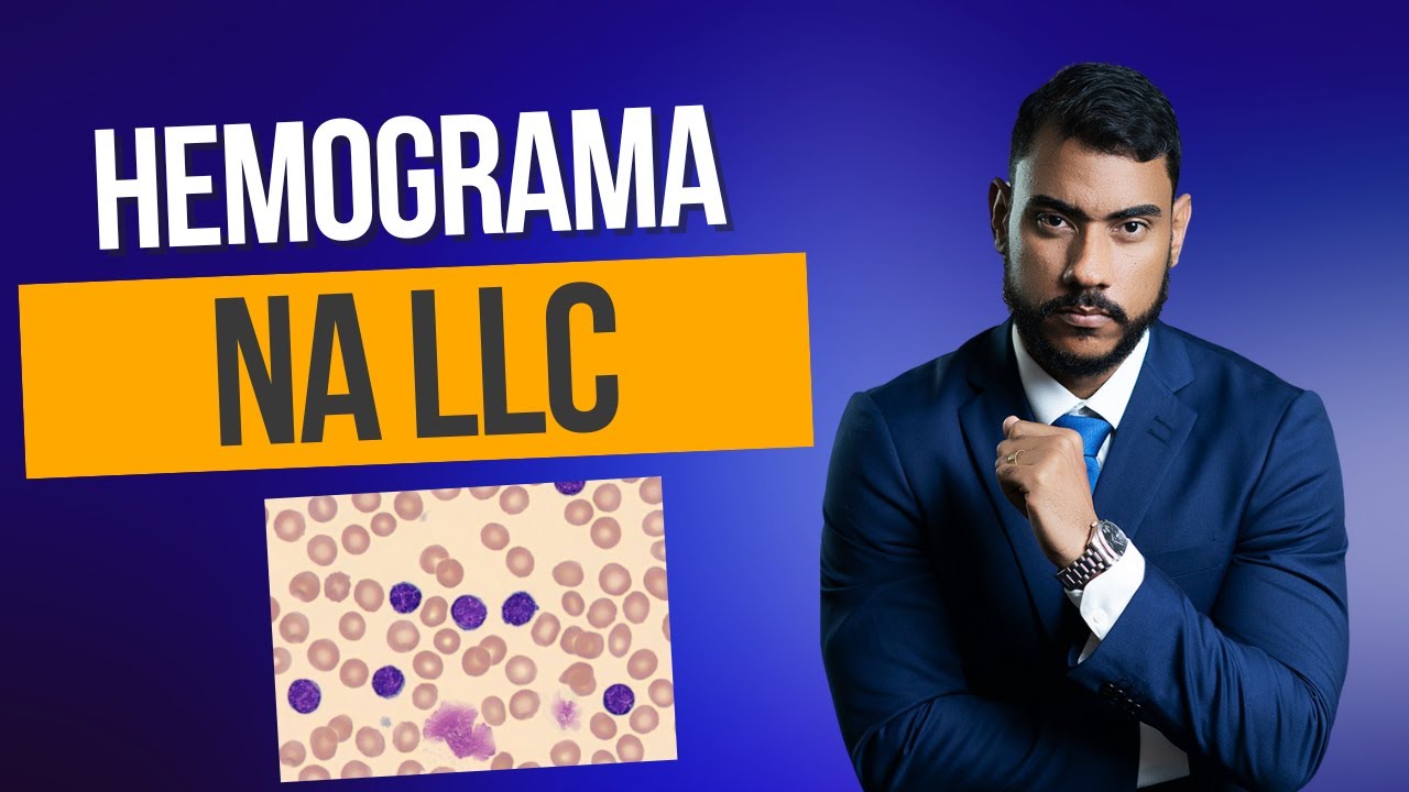 Hemograma na Leucemia Linfocítica Crônica #llc