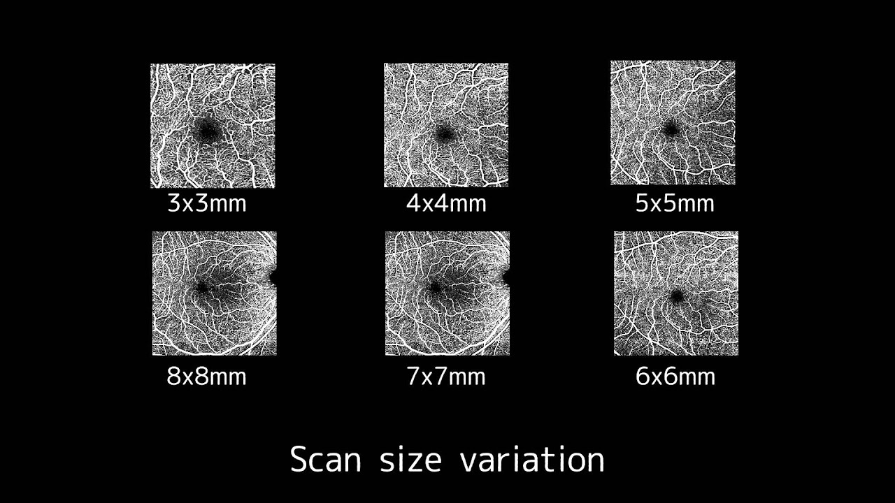 Canon HS-100 OCT Angiography