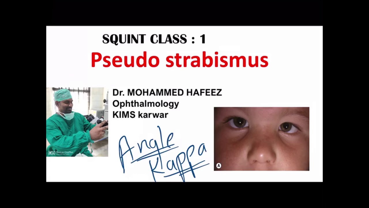 SQUINT CLASS | pseudo STRABISMUS | angle KAPPA