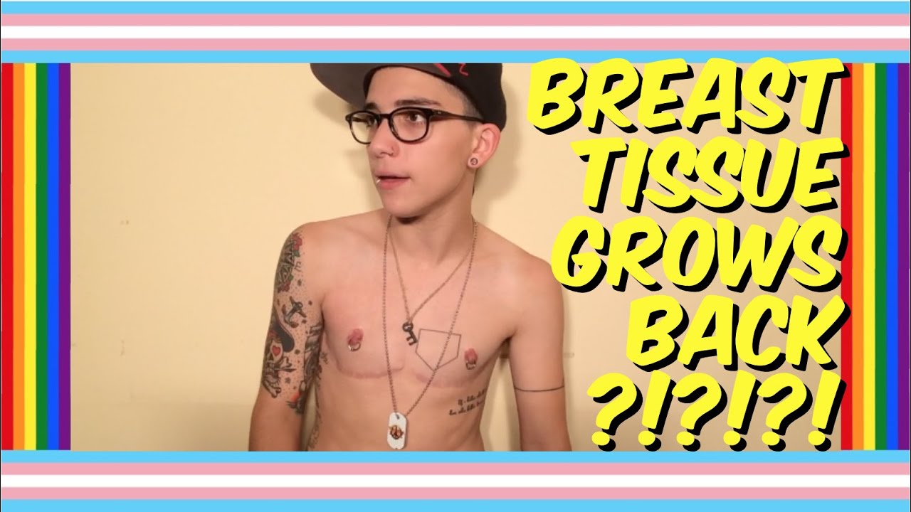 TOP SURGERY W/O TESTOSTERONE!