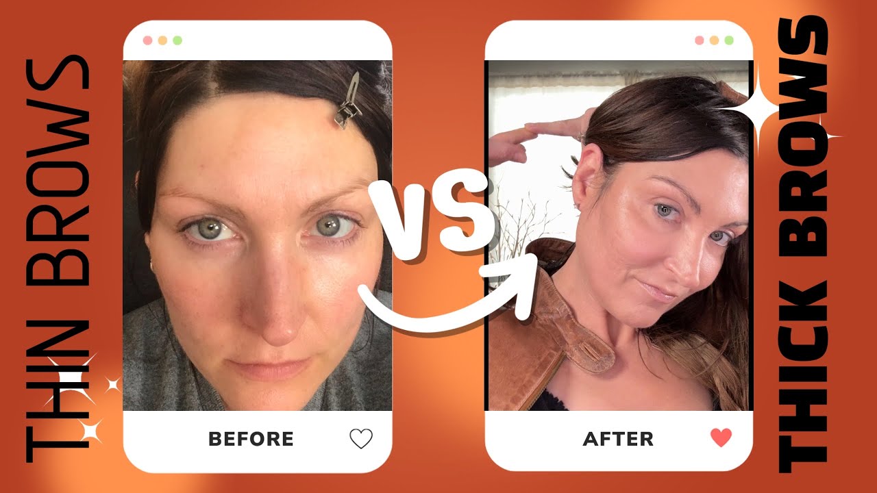 Discover If Minoxidil FOAM Really Boosts Eyebrow Thickness in 2025!