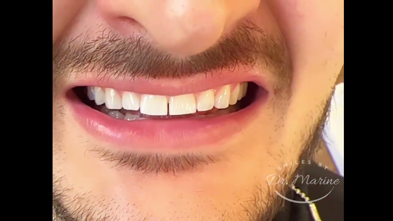 Porcelain Veneers Smile Makeover in Glendale, CA 
