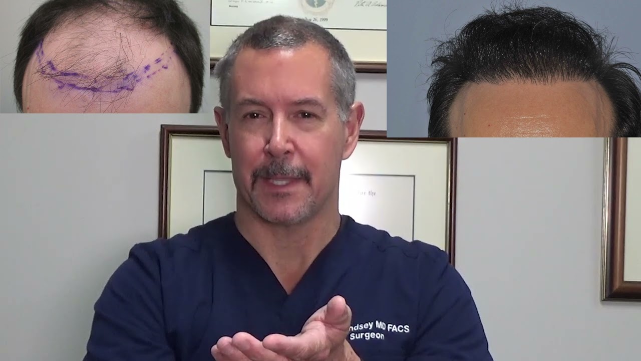 Complete transformation after 2 hair transplants with Dr. Lindsey, including interview | Washington