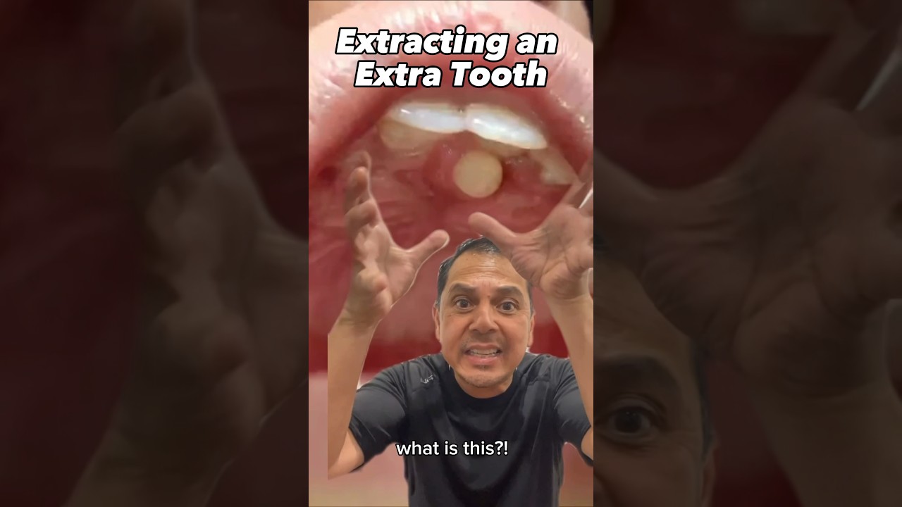 Pulling Out an EXTRA Tooth Explained (Supernumerary Hyperdontia) | View Mobile Dental #shorts