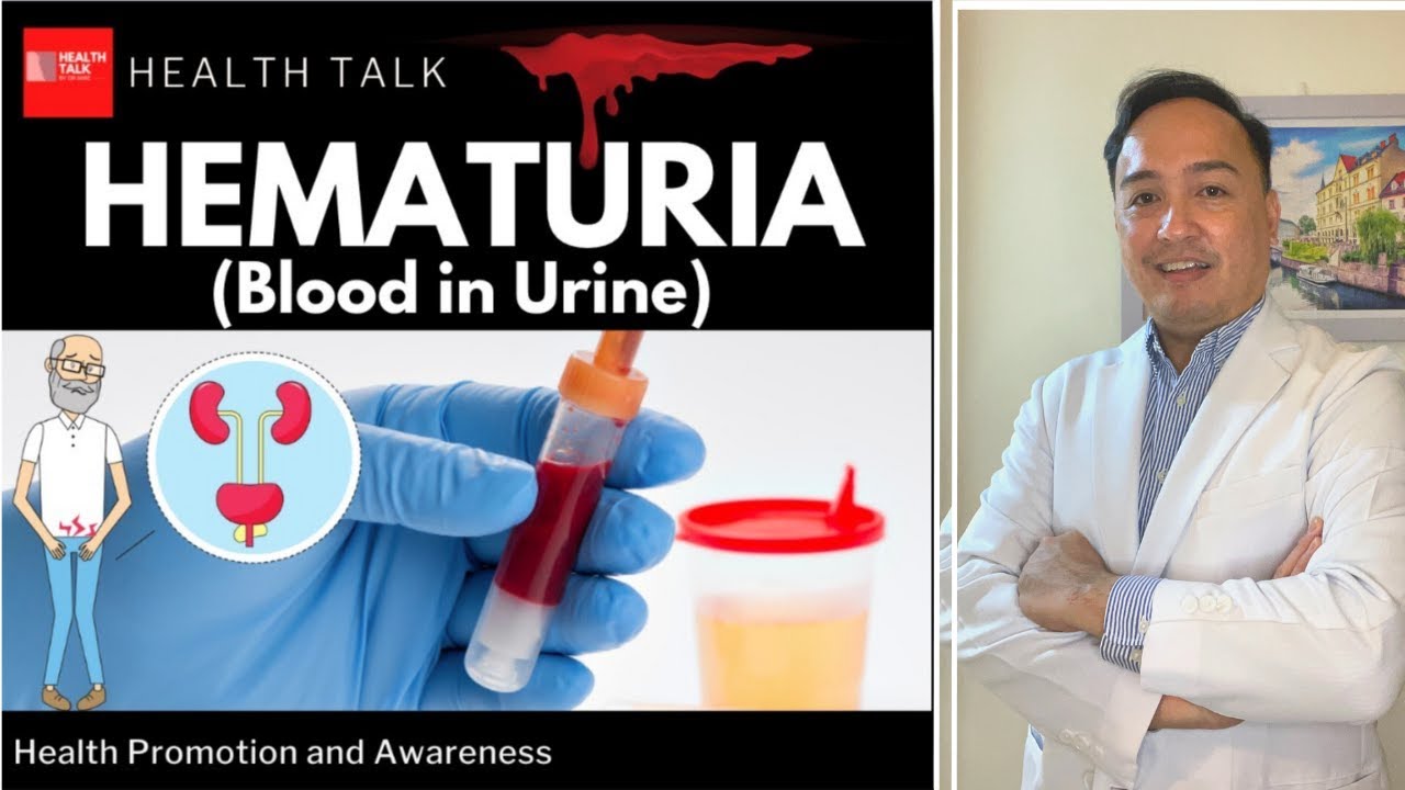 Hematuria: Dugo sa ihi (Symptoms, Causes, Diagnosis & Treatment)