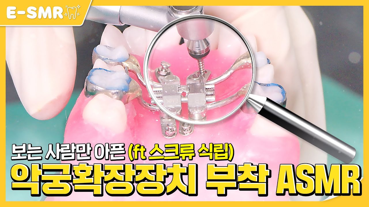 악궁확장장치는 이렇게 부착해요 🦷E-SMR