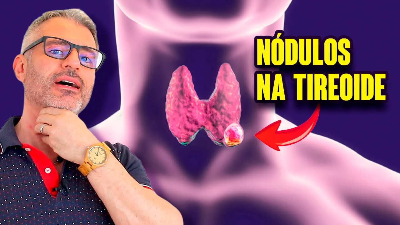 Nódulos na Tireoide: causas e tratamentos