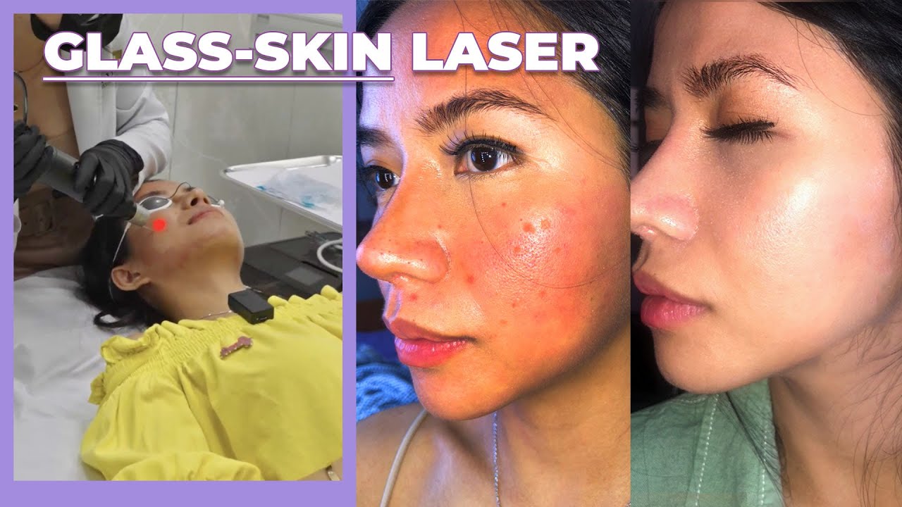 I Got Rid Of My Acne Scars, Dark Spots & Fine Lines with Picosure Laser | #glassskin #acnescars