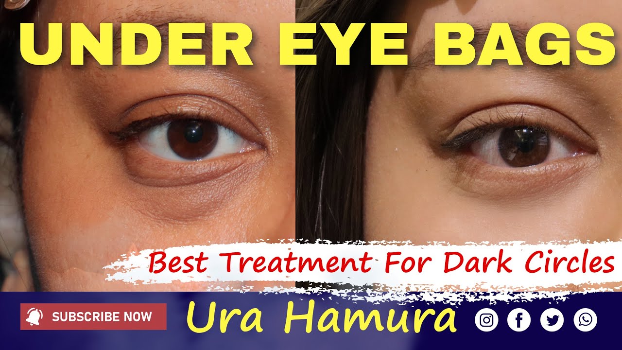 Best Surgery for Under Eye Bags and Dark Circles? Ura Hamra: Real Patient Story & Results
