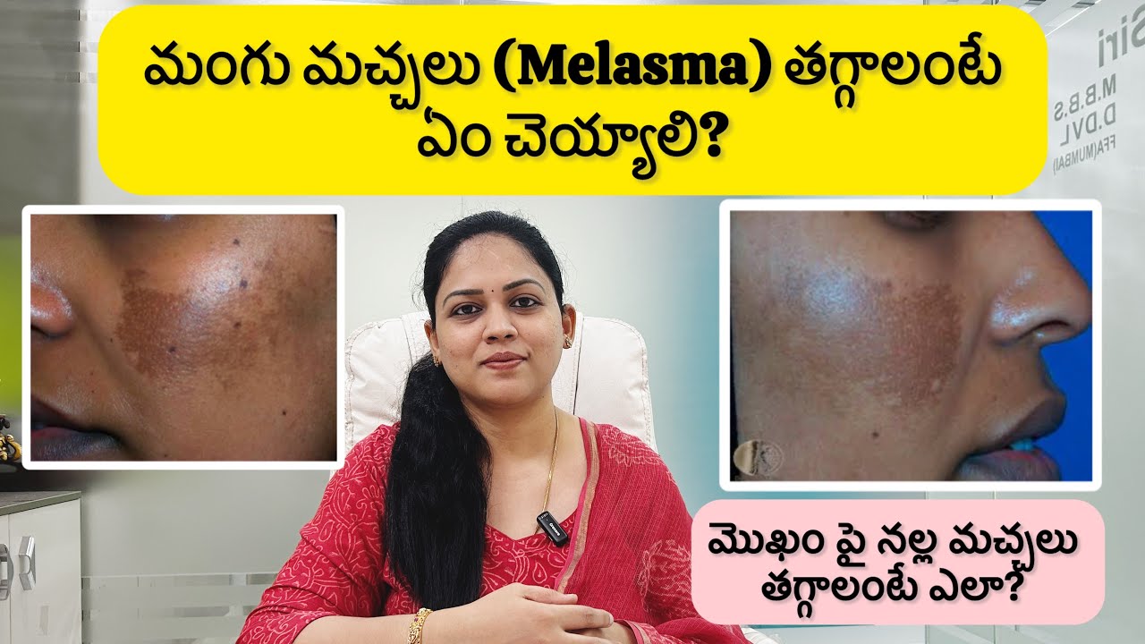 మంగు మచ్చలు | Melasma తగ్గాలంటే ఈ creams వాడండి | @Vizagskindoctor 