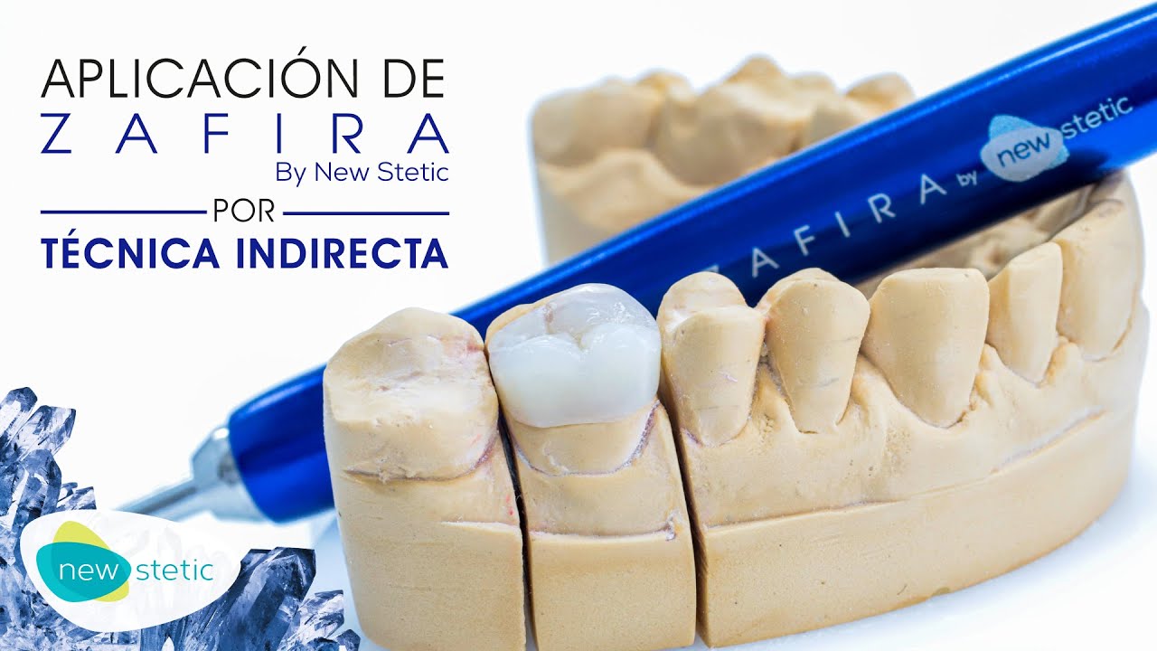 Aplicación de Zafira por técnica indirecta 🦷 | New Stetic S.A.