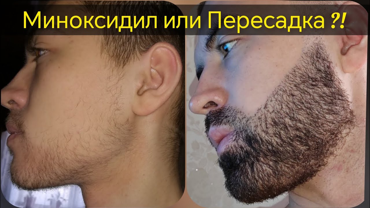 Миноксидил или Пересадка бороды ?! Мой личный опыт. Выпуск 81 Андрей Борода.